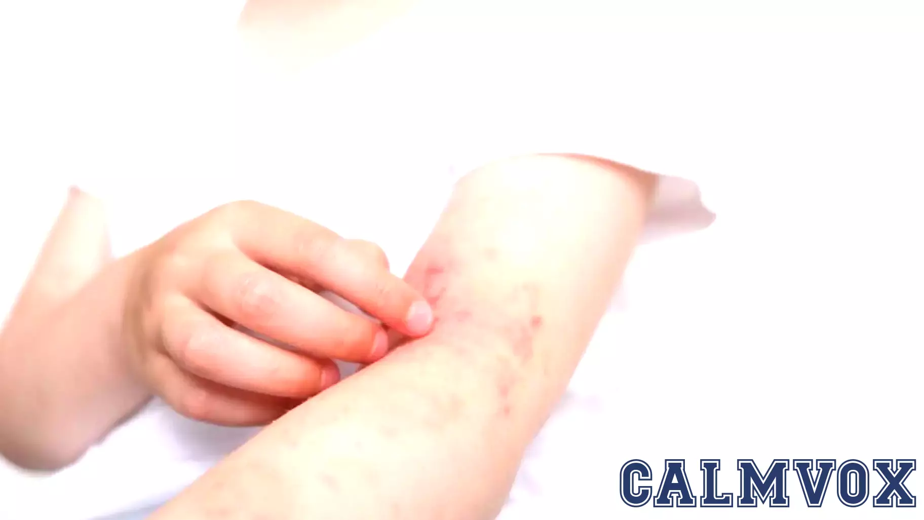 Early Intervention in Atopic Dermatitis Can Transform Outcomes